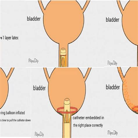 bladder inflation porn|Place a catheter and fill the bladder .